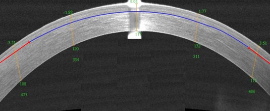 Topograma corneal después de la corrección posterior después de ReLEx SMILE usando el método CIRCLE