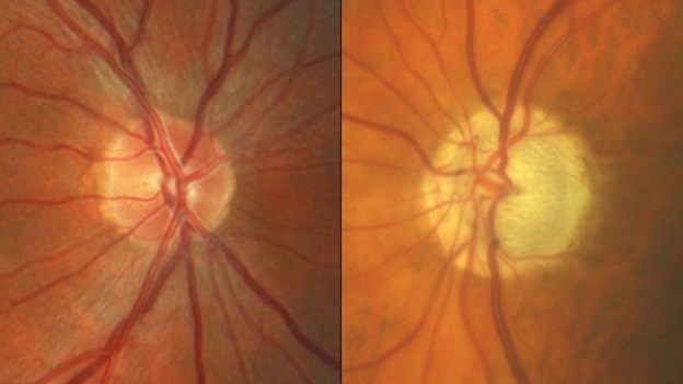 Pale discs of the optic nerves in glaucoma