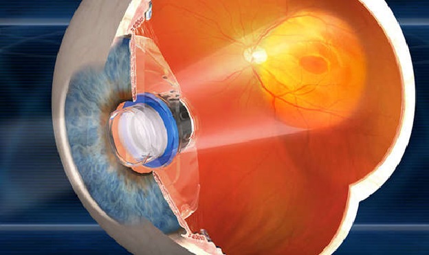 Installing telescopic lenses in the eye