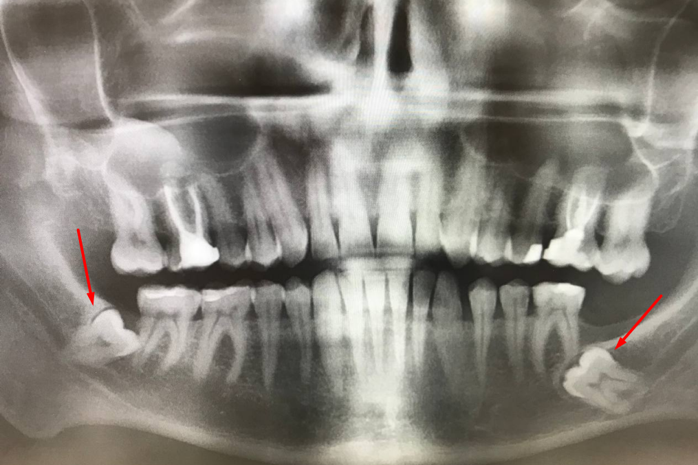 Сколько может болеть зуб после удаления?