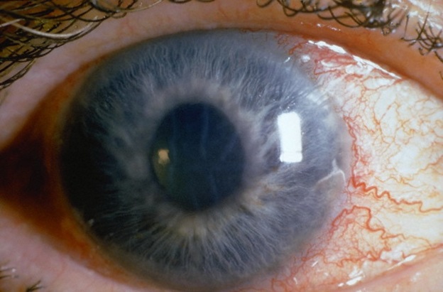 Symptoms of glaucoma