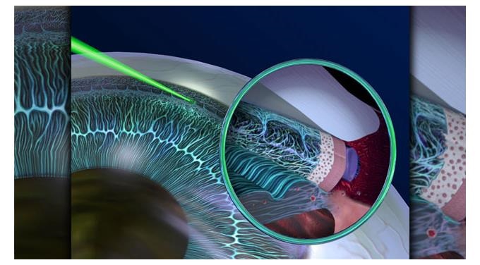 SLT - selective laser trabeculoplasty in glaucoma