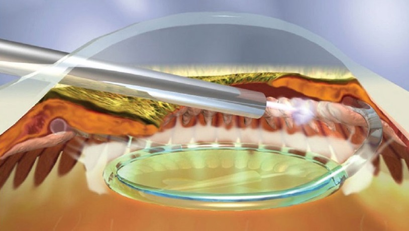 endoscopic cyclophotocoagulation in the treatment of glaucoma
