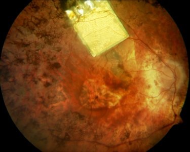 Type of retinal prosthesis in the fundus